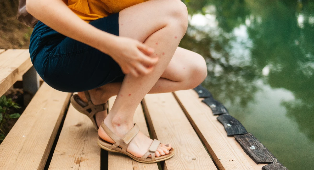 mosquito bites on woman's leg